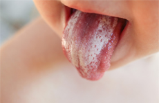 [Translate to Italian:] Tongue of a toddler with white plaque